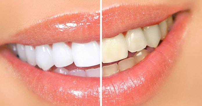 Teeth Whitening at Home