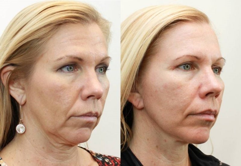 Face before and after biorevitalization