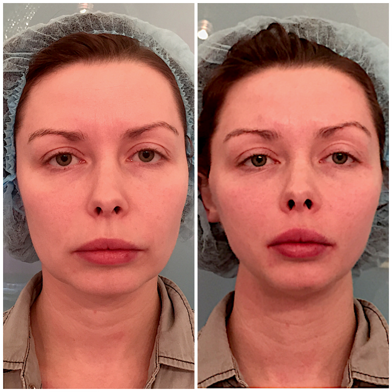 Thread facelift: before and after photos