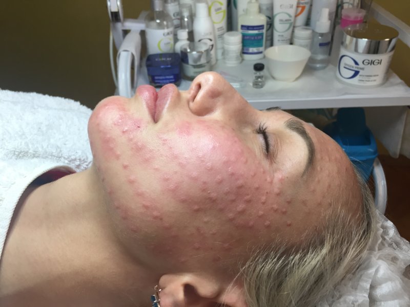 Papules on the face after the procedure