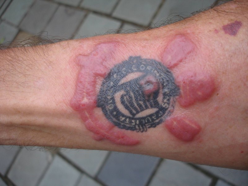 Skin inflammation after tattoo removal