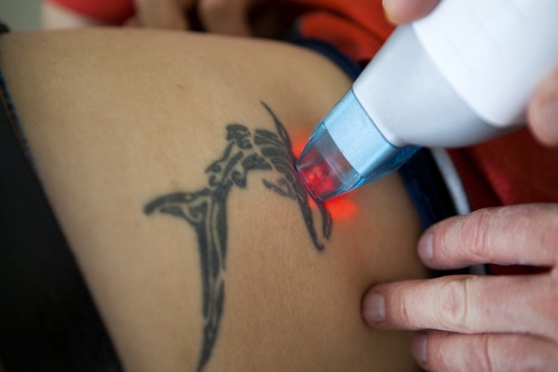 Laser tattoo removal process