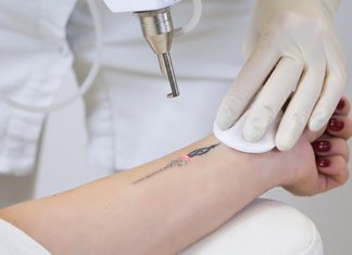 Laser tattoo removal