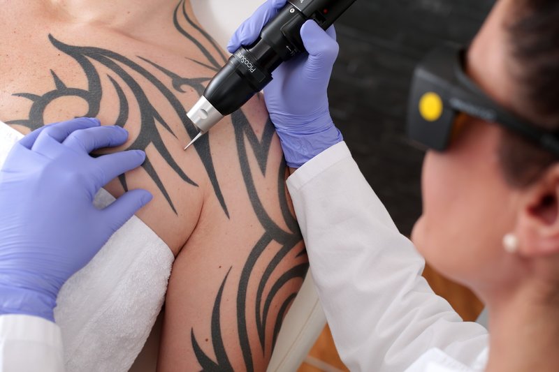 Laser tattoo removal